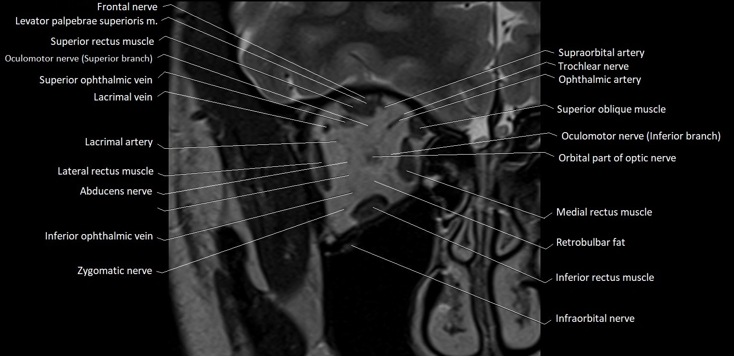 MRI Orbit coronal cross sectional anatomy image 9.webp